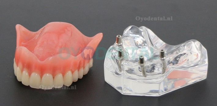 Tandheelkundige studie Tanden Model Overdenture met 4 implantaten Demo Model 6001